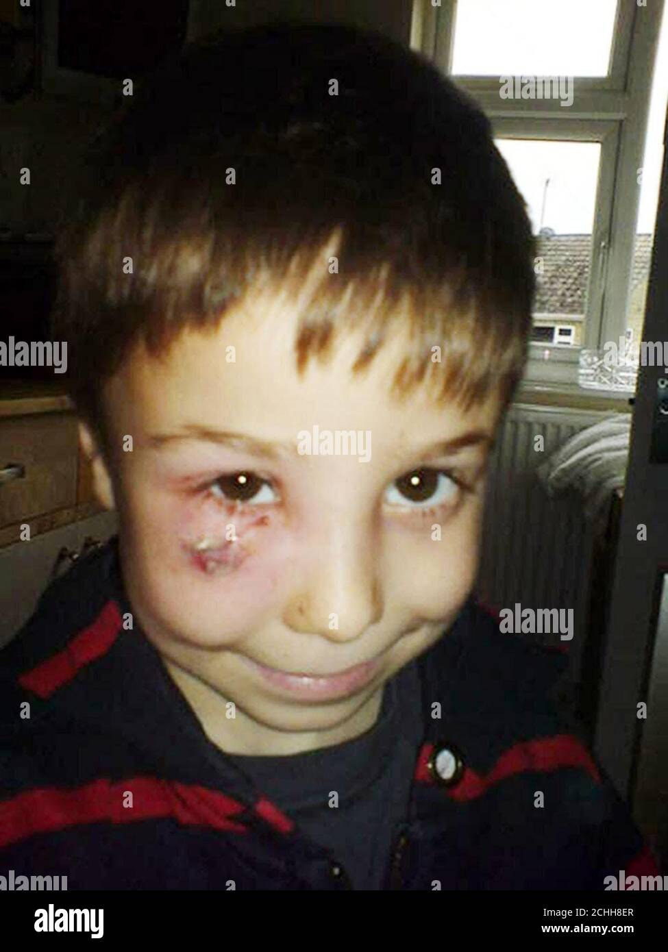 Undated collect photo of Alfie Cornwall with his dog bite. His mother, Stephanie, fined for rushing to see her six-year-old son in hospital after he was attacked by a dog called on speed camera bosses today to show more discretion. Stock Photo
