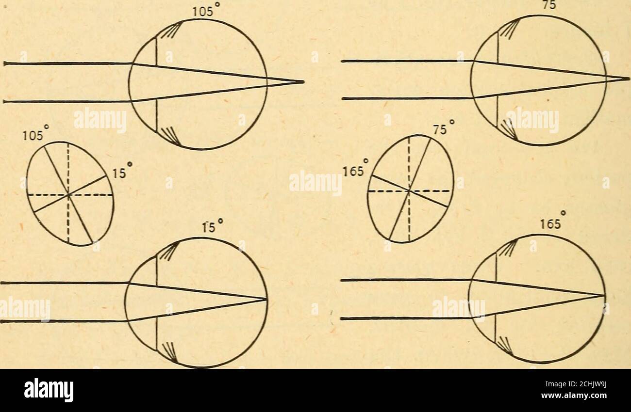 The Refraction Of The Eye Including A Complete Treatise On Ophthalmometry Fig 38 74 The Refractiox Of The Eye Rule Above Reported And Myopic Astigmatism Against The Rule To Be Reported The Refraction Of The Eye Including A Complete Treatise On Ophthalmometry Fig 38 74 The Refractiox Of The Eye Rule Above Reported And Myopic Astigmatism Against The Rule To Be Reported