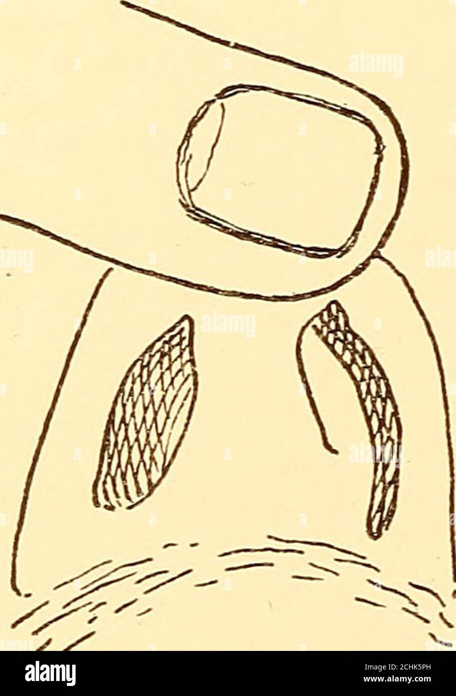 . Diseases of the nose and throat . correcting asymmetries, especially the turbinates oppositea concave septum, may be more noticeable to casual inspec-tion than the asymmetry of the septum itself. The nasal processes of the superior maxilla do nottake part in this adjustment, consequently a deviation ofthe septal cartilage which extends forward into the vestibuleobstructs respiration on that side more than would an equaldegree of deviation farther back. When the deviation ex-tends forward into the vestibule the patient may noticethat on one side it is only by drawing the alae and skin 78 DISE Stock Photo