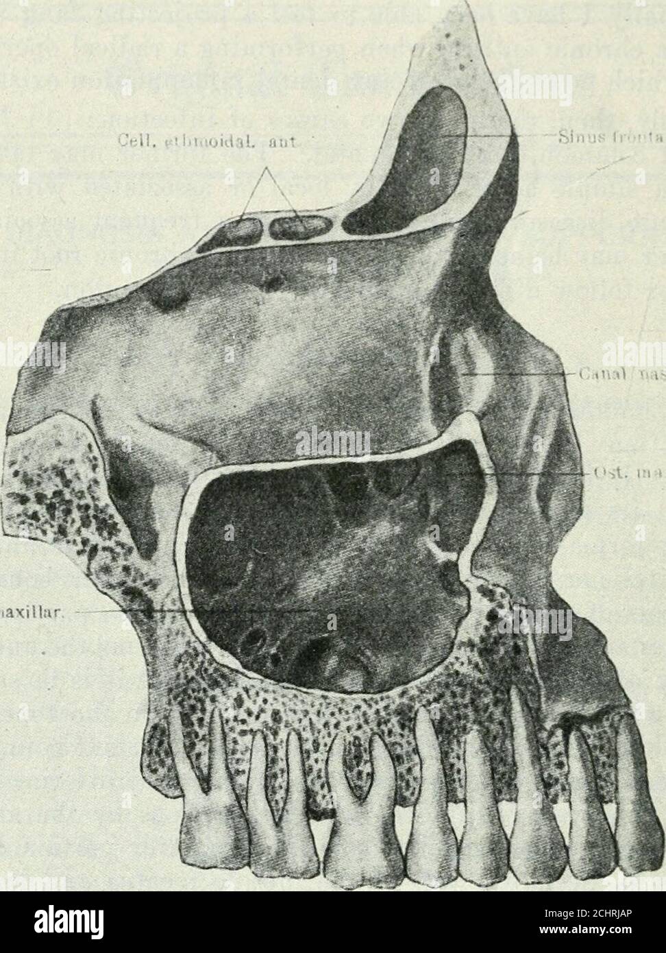 . The Canadian journal of medicine and surgery . e most important boundary,corresponds to the outer wall of the middle and inferior nasalmeati. This wall is divided into two portions by the attach-ment of the inferior turbinal bone, the superior portion corre-sponding to the outer wall of the middle meatus and leavingin its upper and back part an opening, the natural ostium, whilethe lower part is in relation to the outer wall of the inferiormeatus and is marked by a slight ridge showing the situationof the lower end of the lacrymo-nasal duct. The upper por-tion is thin and composed of both bo Stock Photo
