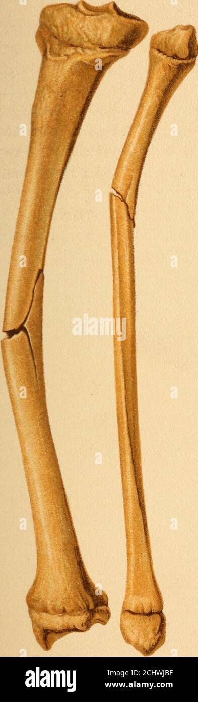  Atlas And Epitome Of Traumatic Collection Inal And Spiral Fractures If The Bone Is 