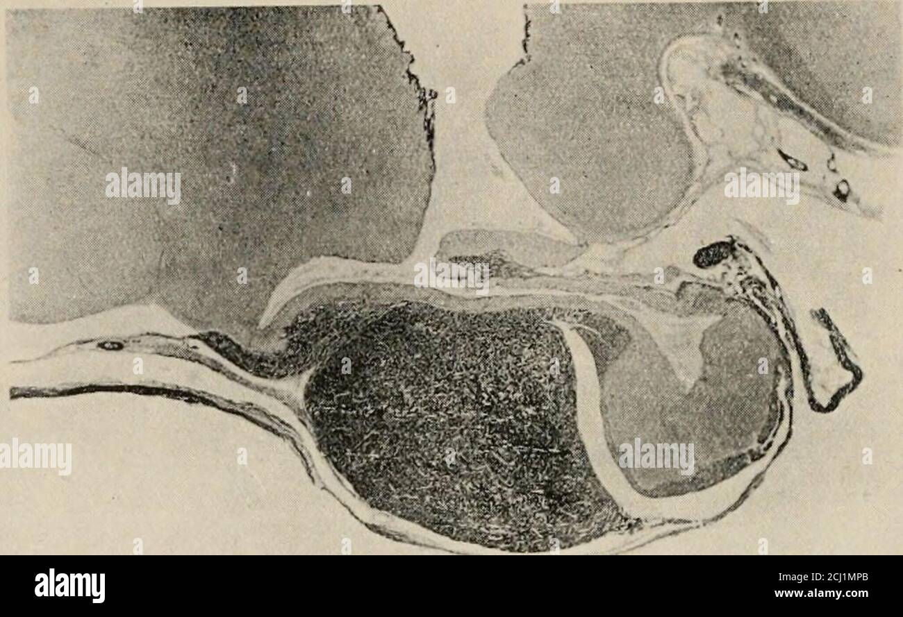 Pars nervosa hires stock photography and images Alamy