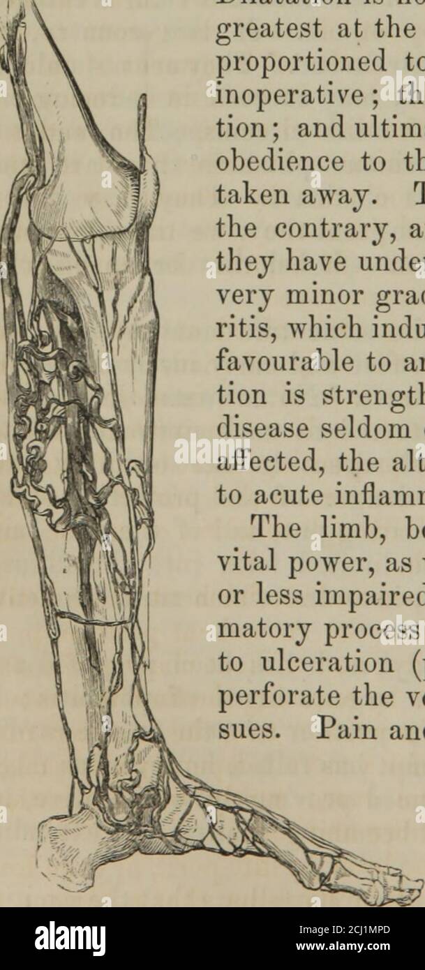 The principles of surgery . ntrary, are thick and rigid. Not improbablythey  have undergone a chronic form of phlebitis, of avery minor grade; analogous  to that of chronic arte-ritis, which induces