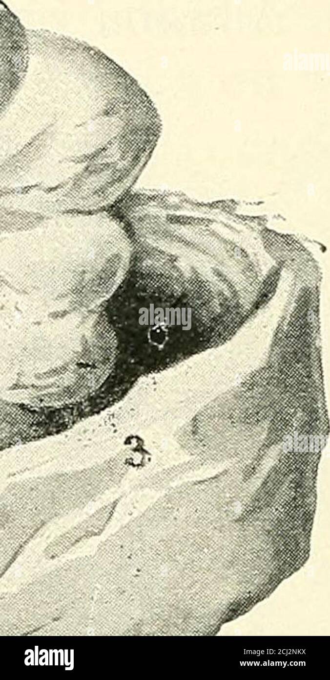 A manual of operative surgery . fig. 112.—sac of femoral hernia excised  valve and preventing the WITH ITS SOLE CONTENTS —AN INFLAMED . vermiform  appendix, which resembled return ol intestine from