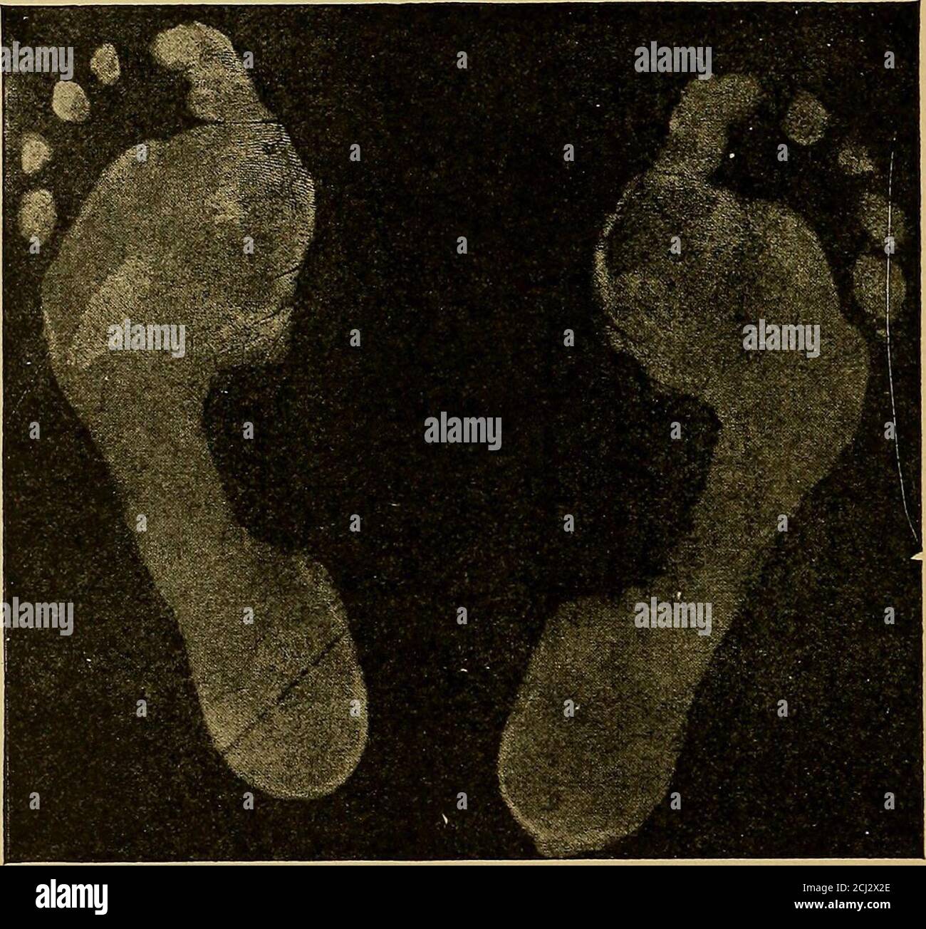 Physical diagnosis . Fig. 207.—Mat-foot. Print of the sole. (Bradford and  Lovett.) tibia and fibula just above the ankle-joint in about forty per  cent ofrachitic cases. The other signs of rickets