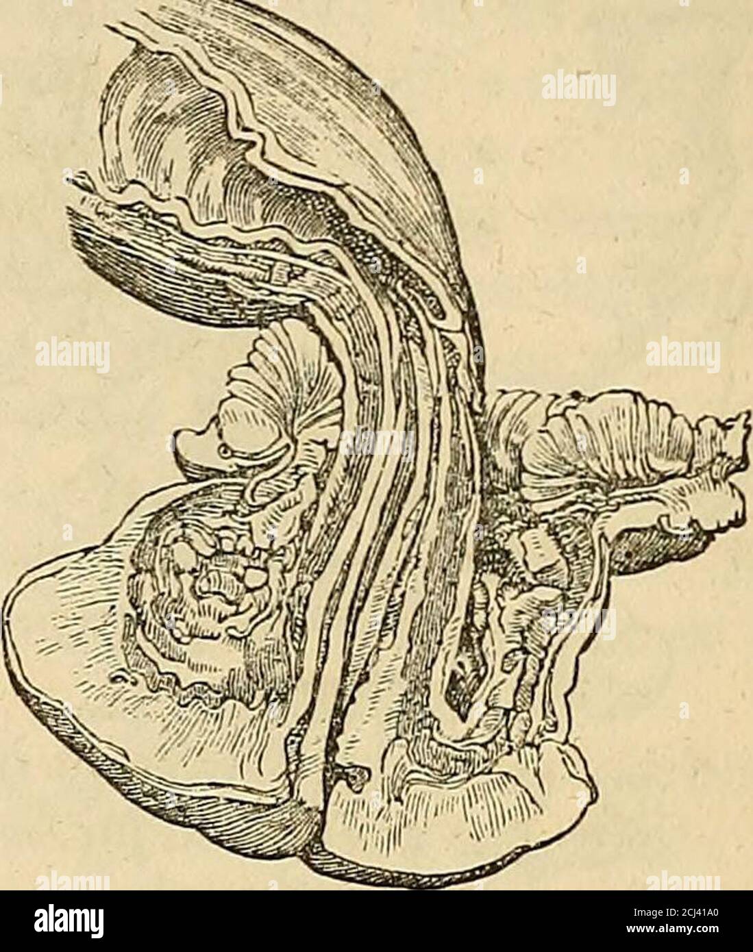 . The principles and practice of modern surgery . emoved by excision with apair of scissors: the operation must be repeated, if necessary, until thesymptoms are relieved and the pouches removed.—Ed.] X. Rhagades—fissures and excoriations about the anus—produce theutmost pain during the passage of evacuations, and if neglected, may leadto spasm and permanent stricture of the sphincter. Jreatment.—Aperients and alteratives,—regular diet,—astringent appli-cations, such as decoction of rhatany, zinc lotion, borax and honey, — ormercurial ointment, or ung. hydr. nitrat. dilut., to which a little ex Stock Photo