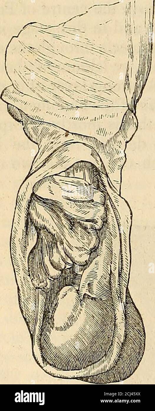 . The principles and practice of modern surgery . ame as those of the oblique variety, except the cre-master, for it has no connexion with the cord. The epigastric artery runsexternal to the neck of the sac. This hernia may, however, push the con-joined tendon before it, instead of bursting through it. The spermaticcord generally lies on its outer side. 3. The congenital hernia is a variety of the oblique, and is so calledbecause that state of parts which permits of it only exists at or soon afterbirth. A portion of omentum or intestine accompanies the testicle in itsdescent, and passes down w Stock Photo