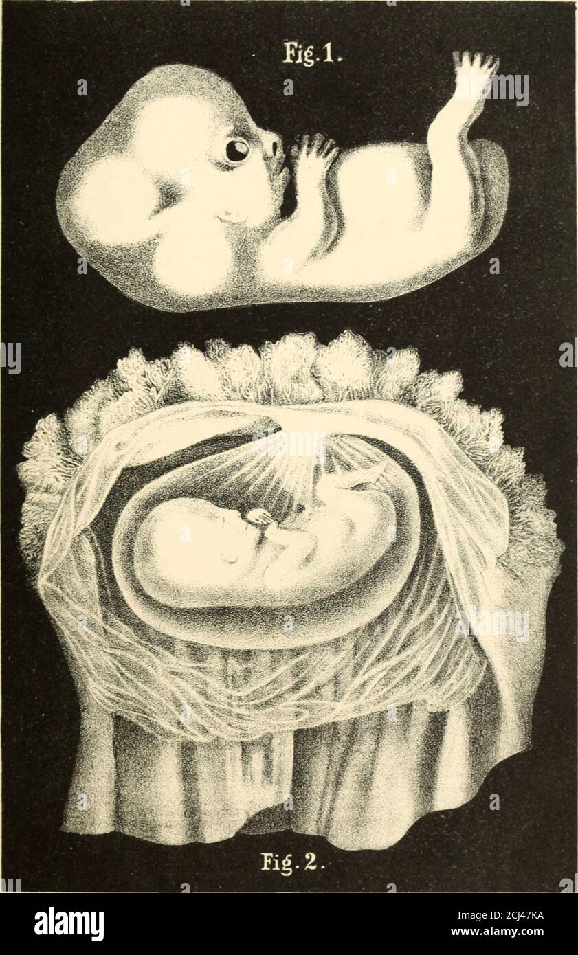 . The science and art of midwifery . Fig. i.). i. exochorion : 8, endochorion ; r,umbilical vesicle; i. amnion; P, pedi-cle of allantois. Plate III.. Fig. 1.—Human embryon, at the ninth week, removed from the membranes; three times the natural siz*&gt; (Erdl).Fio. 2.— Human embryon, at the twelfth week inclosed in the amnion; natural bum (Erdl). DEVELOPMENT OF THE OVUM. ;,;; week the allantois reaches the chorion, over which it spreads and formsa complete vascular lining. According to the usual acceptation, thevessels of the allantois everywhere penetrate into the villi of thechorion. Then the Stock Photo