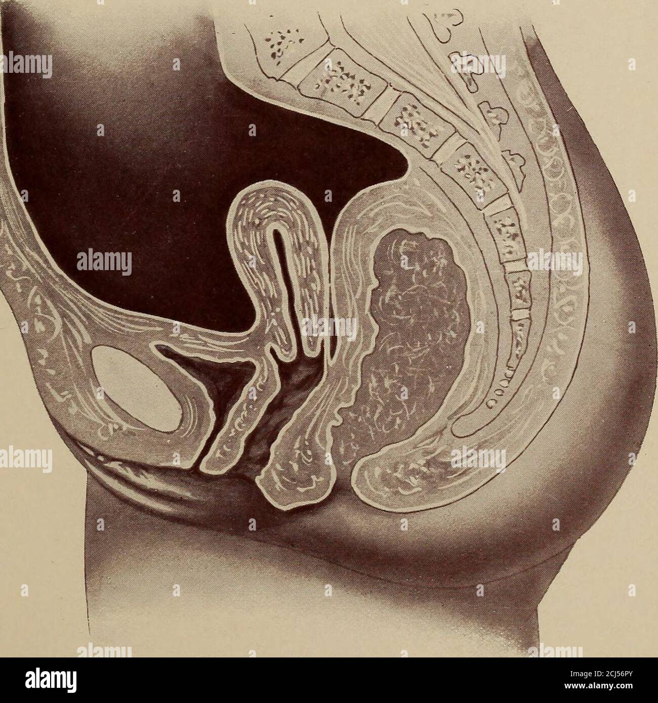 . The diagnosis of diseases of women . Anteposition of tine uterus. A retrouterine haematoeele fills theeul-de-sae of Douglas and the space between the uterus and. sacrum.The uterus is crowded forward. FIG. 2,. Anteposition. The loaded rectum crowds the uterus forward intoanteposition when the bladder is empty. The cul-de-sac of Douglasis almost obliterated. When the rectum is empty the uterus will fallback into the normal position. PLATE XXVI. FIG. Stock Photo