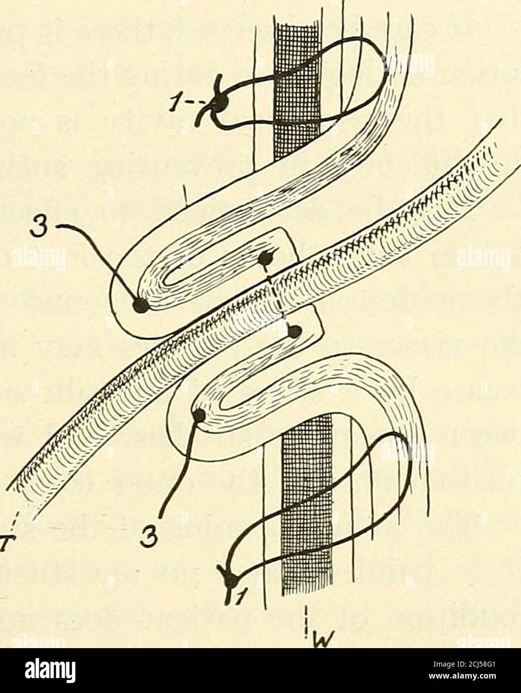 Gastrostomy tube hi-res stock photography and images - Alamy