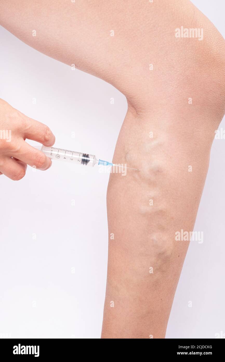 Varicose vein leg swelling hires stock photography and images Alamy