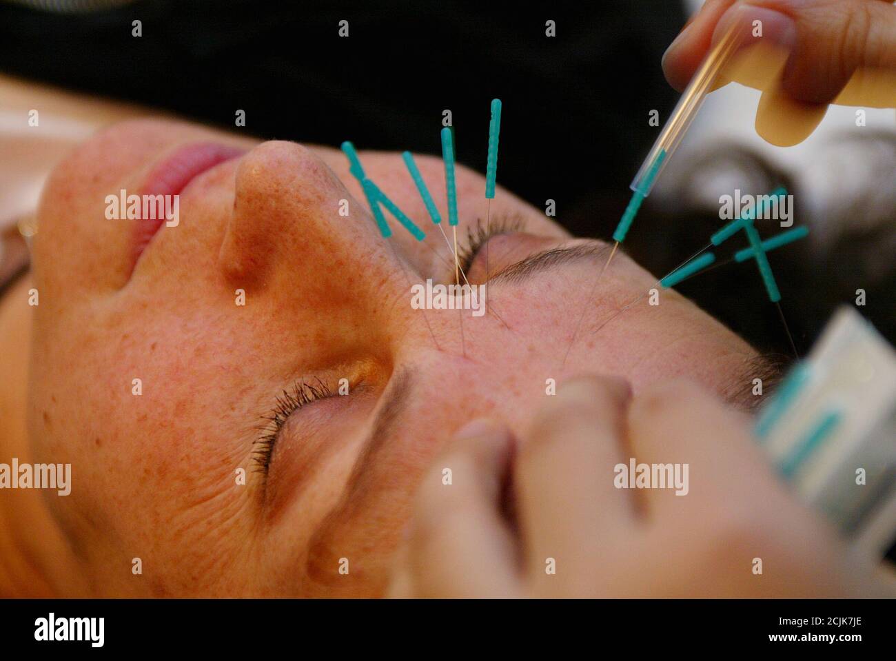Acupuncture channels hires stock photography and images Alamy
