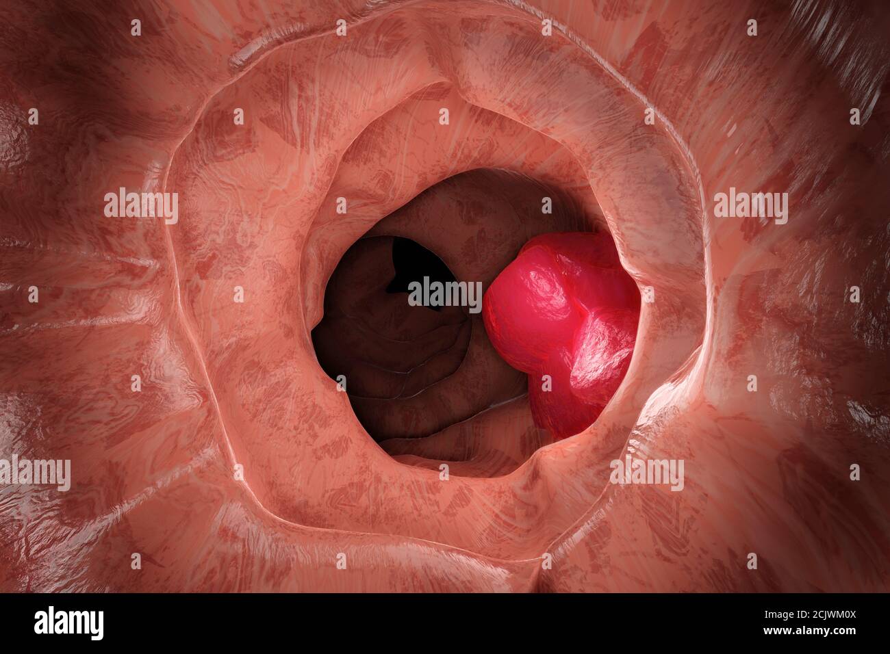 3D Illustration of the colon during a enteroscopy with a intestinal or bowel cancer tumor visible. Stock Photo