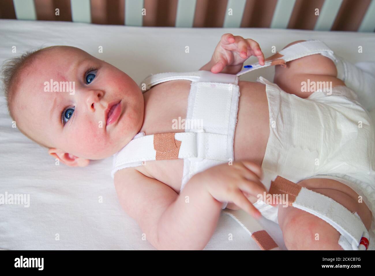 4 Month Old Baby With Hip Dysplasia Being Treated With A Pavlik Harness Stock Photo Alamy