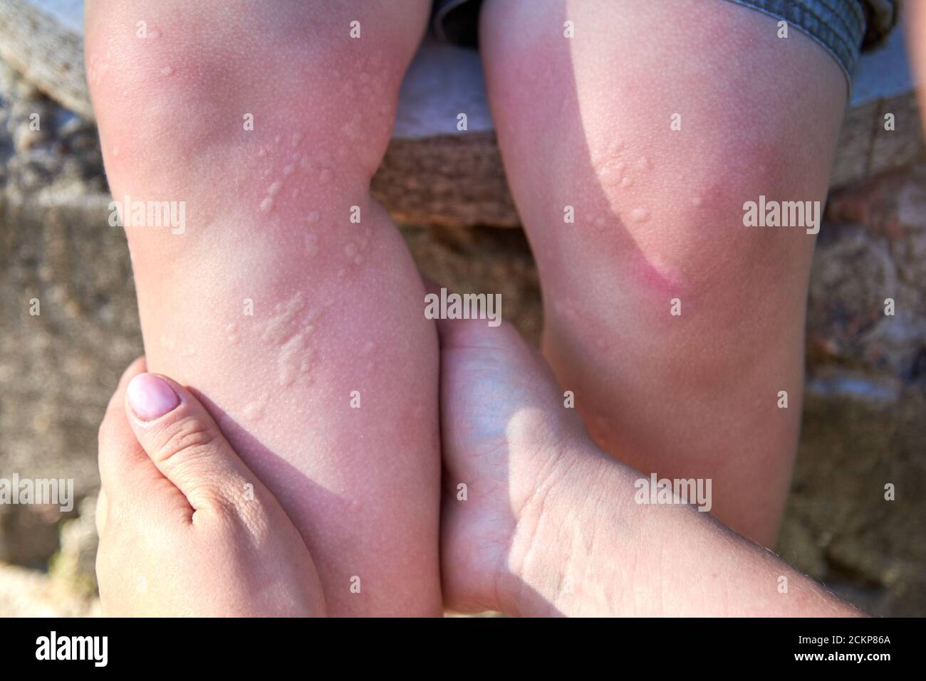 Burn blister arm hires stock photography and images Alamy