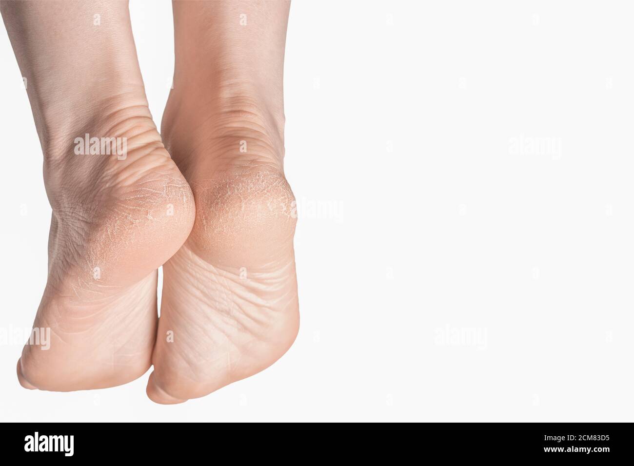 Dry and cracked soles of feet on white background. Foot treatment