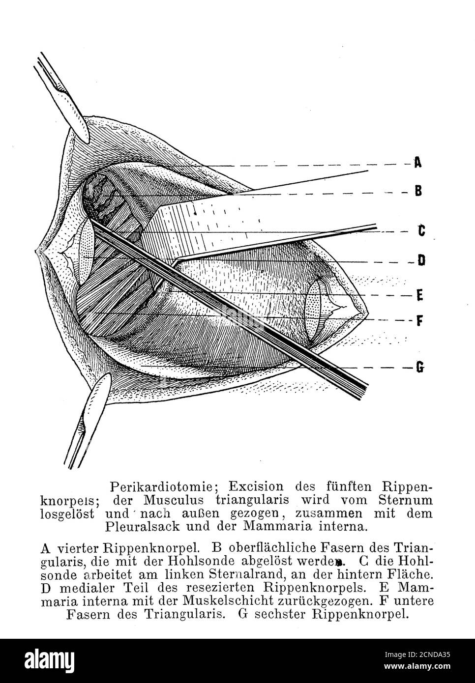 Healthcare, medicine and surgery: pericardiotomy, vintage illustration with operation description in German Stock Photo