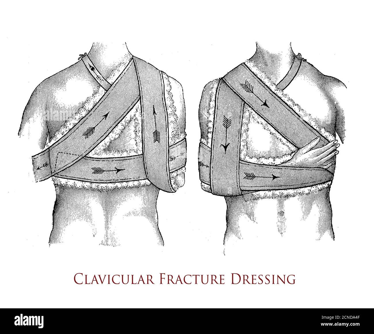 Healthcare and medicine: drawing explaining how to perform a clavicular fracture dressing, vintage illustration Stock Photo