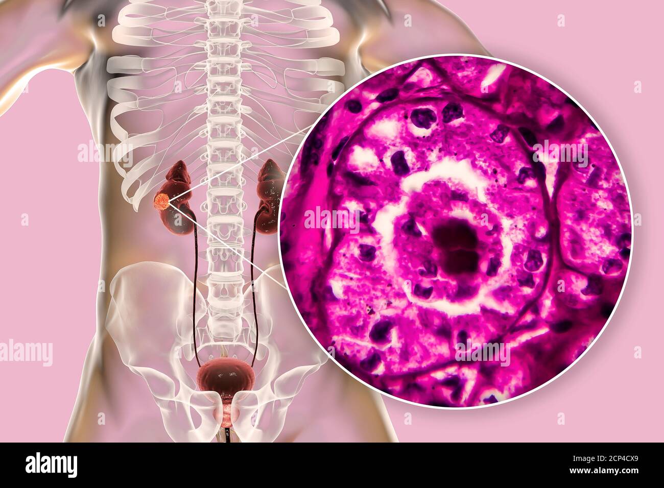 Kidney cancer, computer illustration and light micrograph. Stock Photo