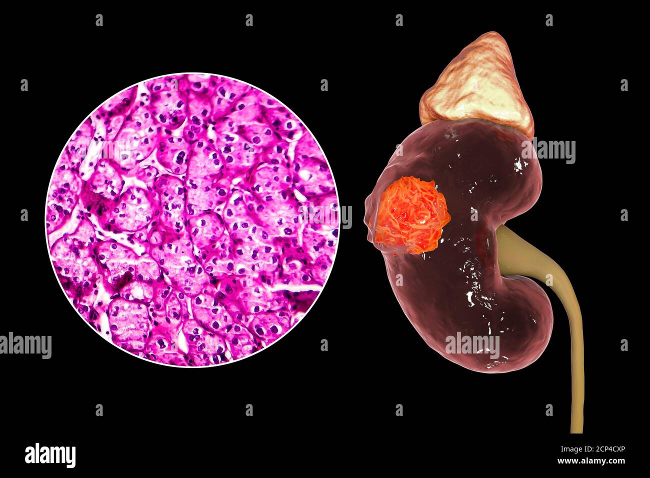 Kidney cancer, computer illustration and light micrograph Stock Photo Alamy