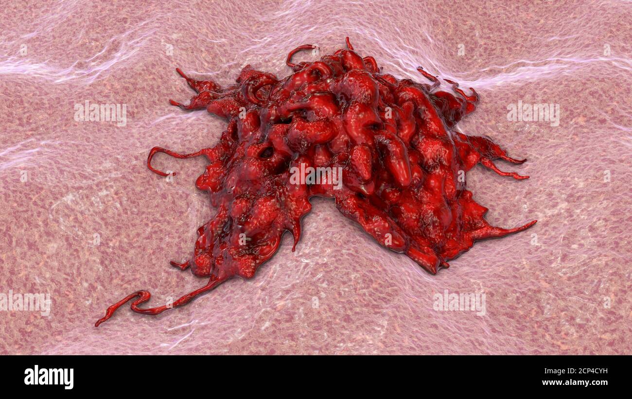 Cancer cell, computer illustration Stock Photo - Alamy