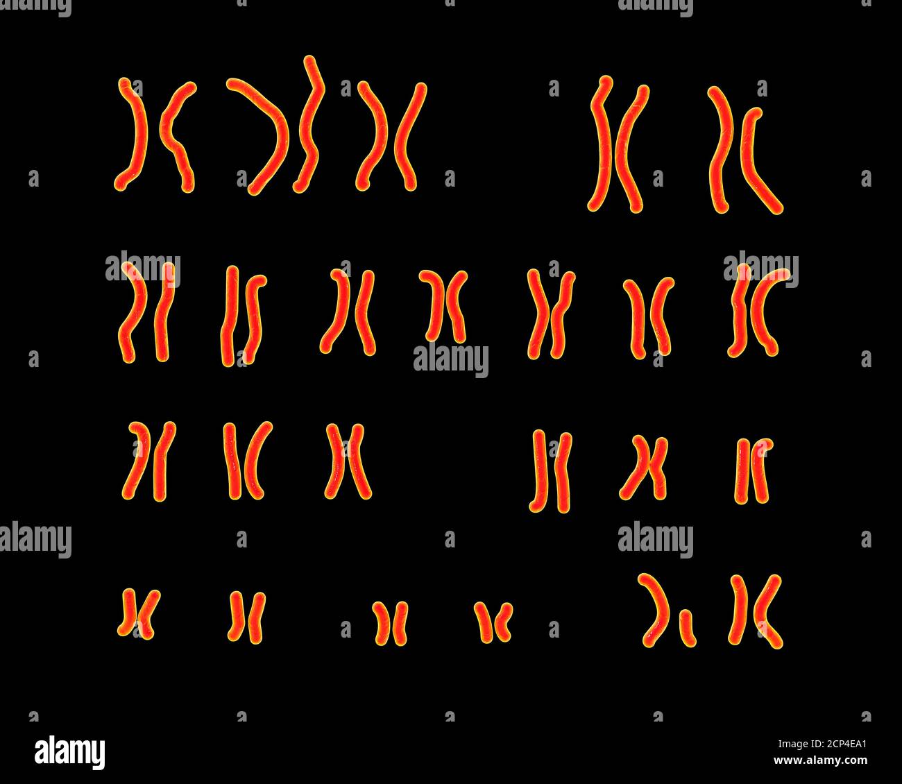 Karyotype of a patient with cri du chat syndrome (also known as Cat cry syndrome), computer illustration. Cri du chat syndrome is a group on syndromes Stock Photo