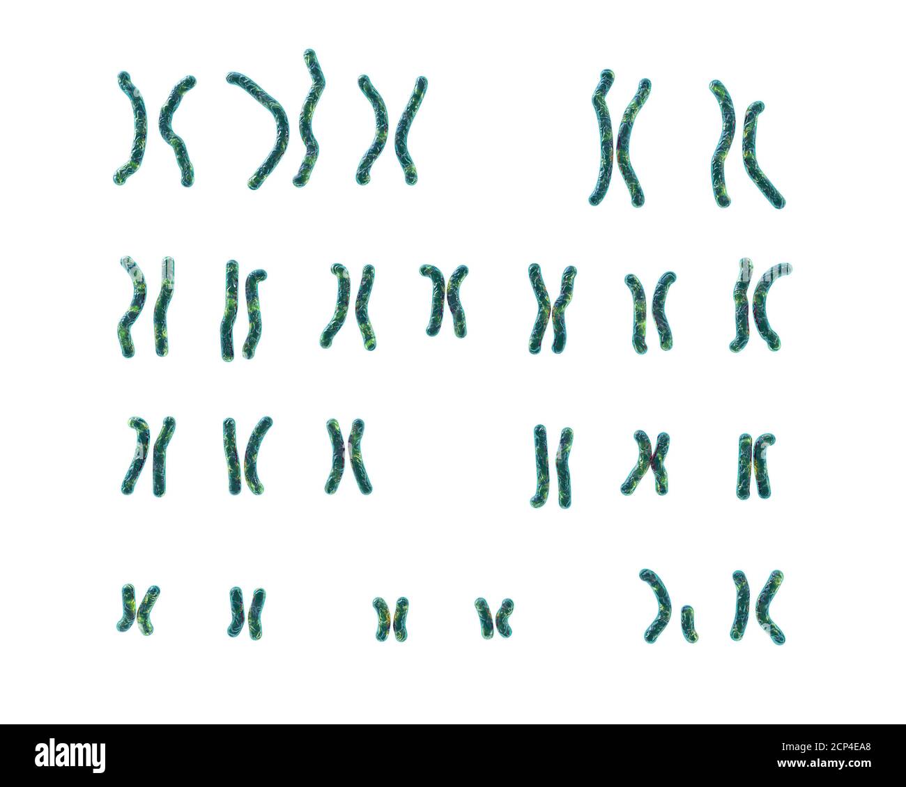 Karyotype of a patient with cri du chat syndrome (also known as Cat cry syndrome), computer illustration. Cri du chat syndrome is a group on syndromes Stock Photo