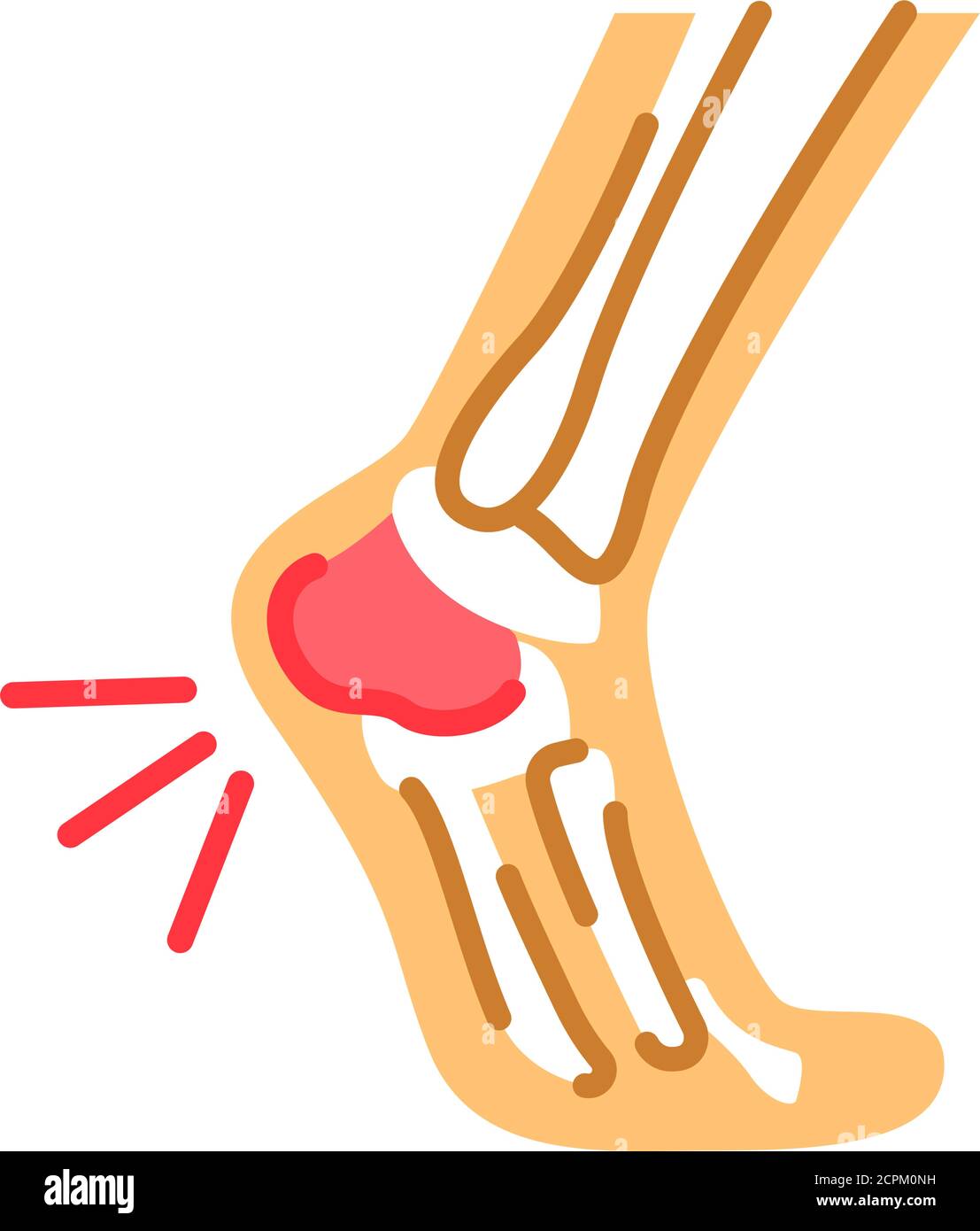 Foot heel pain flat color icon. Heel spur, calcaneal apophysitis ...