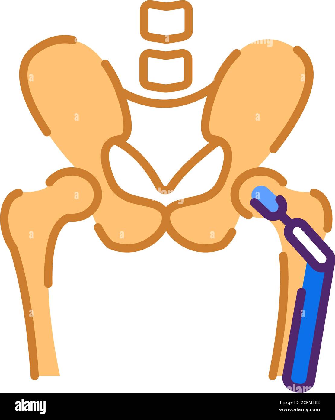 Arthroplasty flat color icon. Hip replacement implant installed in the pelvis bone. Sign for web page, mobile app, button, logo. Vector isolated Stock Vector