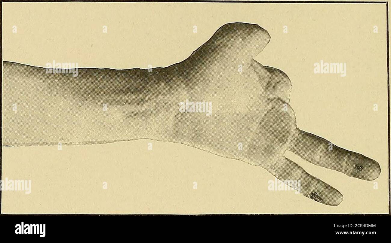 . Railway surgery : a handbook on the management of injuries . FIG. 59.—Loss of Entire Finger, and removal of head of metacarpal bone. is invariably in the way afterward. When a phalanx isleft, the flexor and extensor tendons should not be cutoff close but left long enough to be united over theend of the bone, thus giving a degree of motion to thestump which would otherwise be a useless stub (see Figs.60 and 61). If all the fingers are gone, and the palmar or dorsalsurface is exposed, utilize all the available skin from thetorn fingers, if necessary to close over any gap left in theparts to be Stock Photo