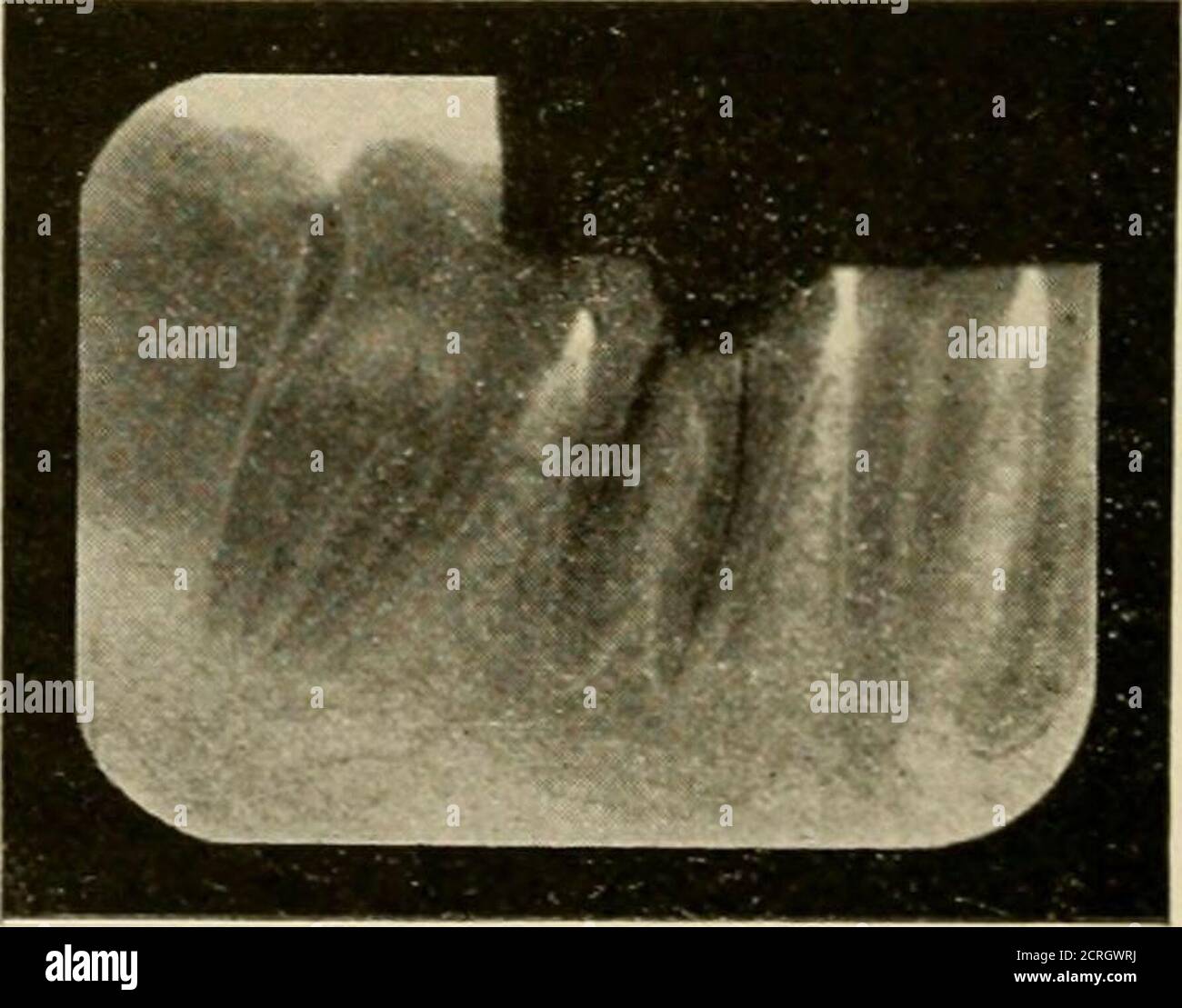 . Elementary and dental radiography / by Howard Riley Raper . Fig. 436A. Wires in lower first molar. X-rays passed through tooth diagonally; arrowsNo. 1 and No. 2, Fig. 436. Fig. 436B. Same case as Fig. 4..ii.. nudewith X-rays passing through tooth as indi-cated by arrow No. 3. Fig. 436. The wiresin the mesial canals are superimposedthroughout most of their length. RE. WING RADIOGRAPHS 387 Stock Photo