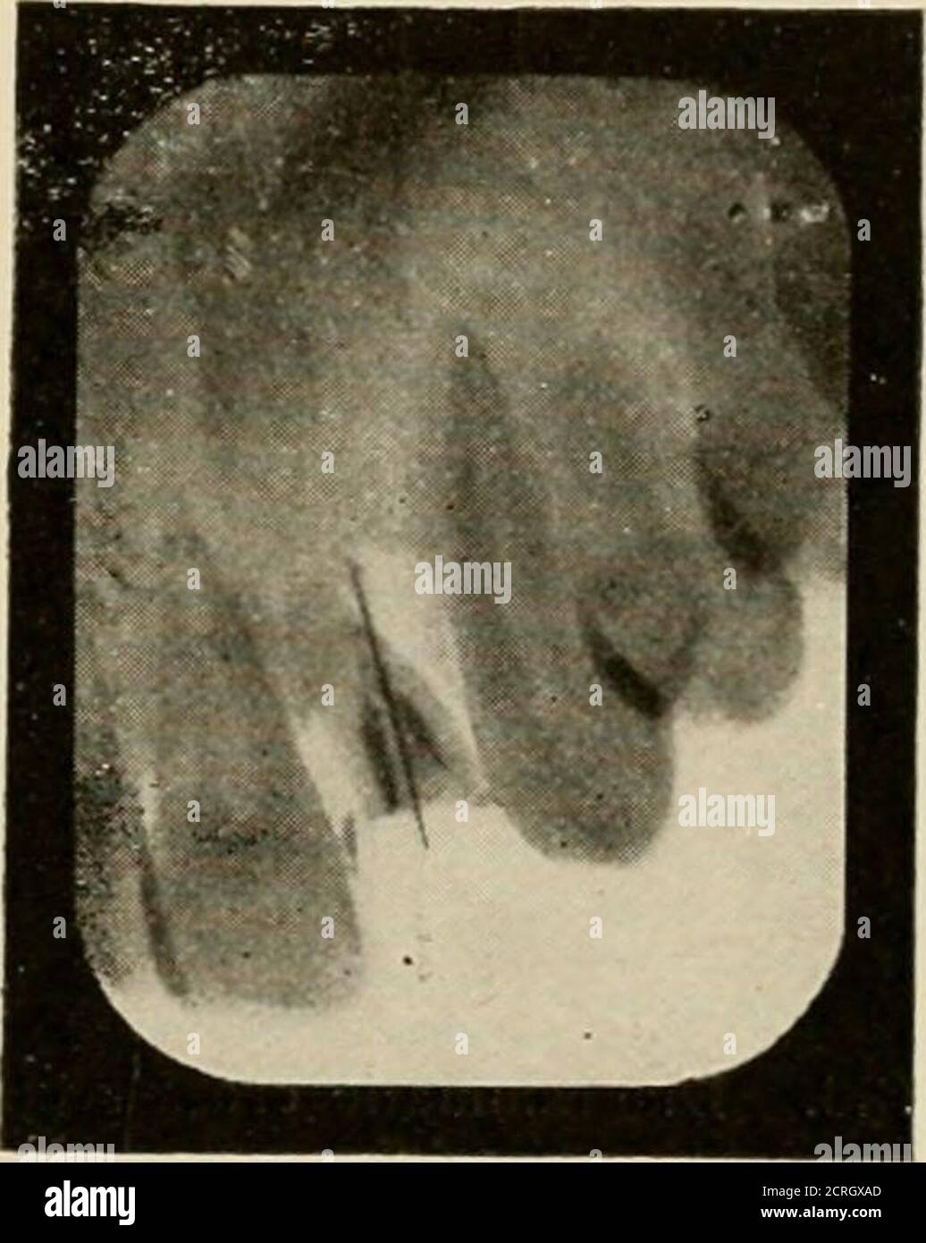 . Elementary and dental radiography / by Howard Riley Raper . Fig. 433. Same as Fie. 432. Radiograph notFie. Al. Wire apparently followine canal in distorted. See wire passing through upper lateral runt. Distorted radiograph. side of root to the distal. have heen directed through the tooth at a different angle (arrow No. 3,Fig. 436) and the outline of the roots is comparatively distinct. When the X-rays pass through the tooth as indi-Tifl. 436. cated by arrows 1 and 2, Fig. 436, the outline of the roots will be more or less indistinct; when the rayspass straight through the tooth, as indicate Stock Photo