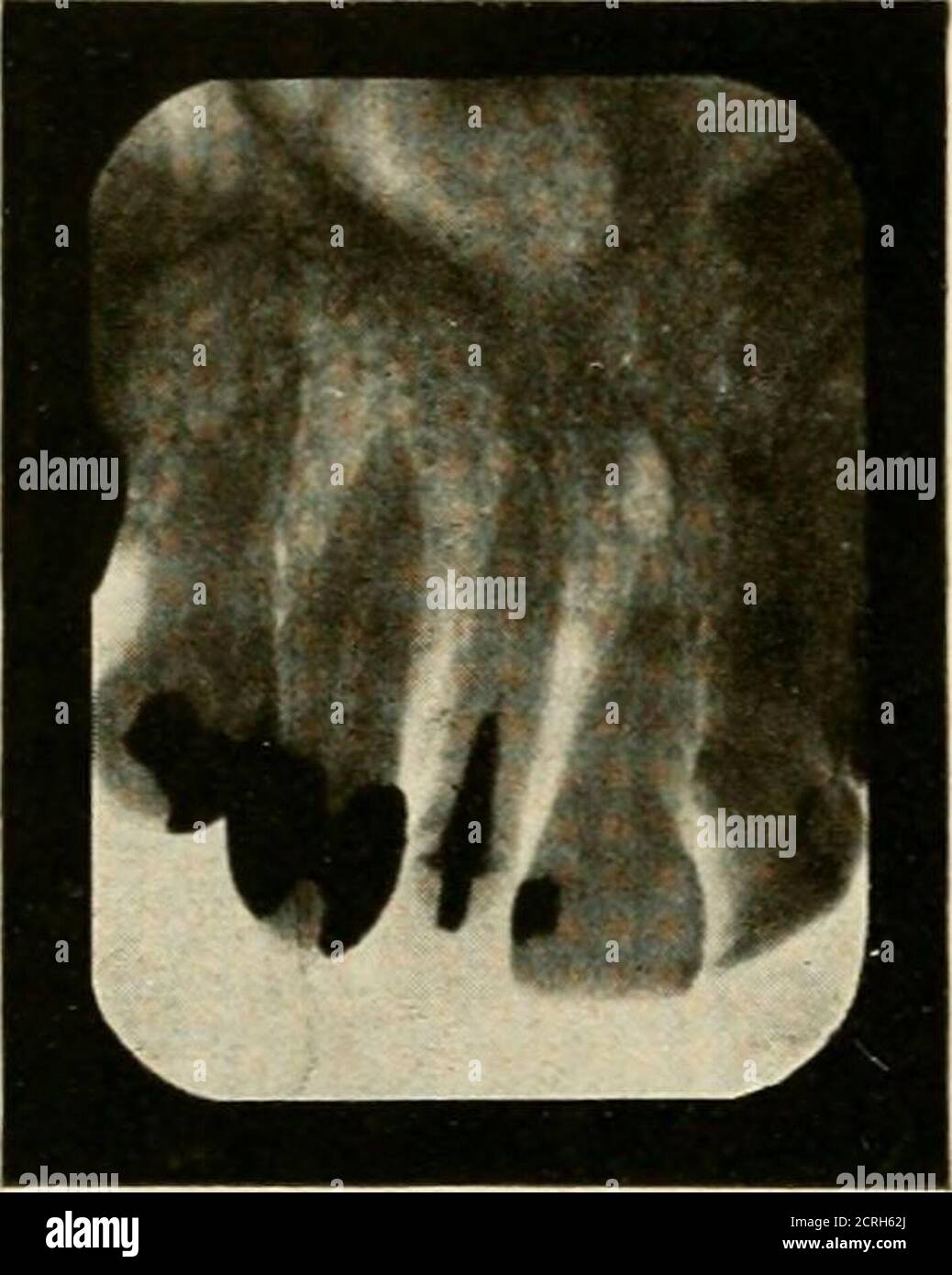 . Elementary and dental radiography / by Howard Riley Raper . Fig. 390. The mental foramen at