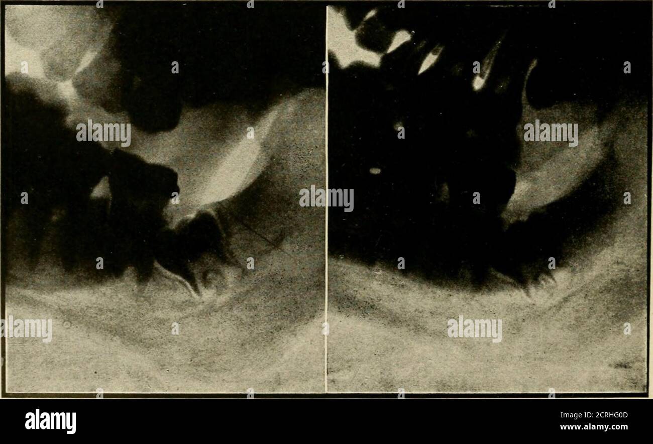 . Elementary and dental radiography / by Howard Riley Raper . ¥ co Fig. 343. No stereoscopic effect at all is obtained with the radiographs mounted as in this figure. We now come to a more definite consideration Special teebnic °^ dental stereoscopic radiography. Stereoradio- for Dental Stereo- graphs of the lower teeth may be made on plates Radiography. using the plate changer illustrated in Fig. 327. Fig. 344 is such a stereoradiography Fig. 344 was made from the pose illustrated in Fig. 330.. Fig. 344. Though the stereoscopic effect is not very good the figure is representative of whatcan b Stock Photo