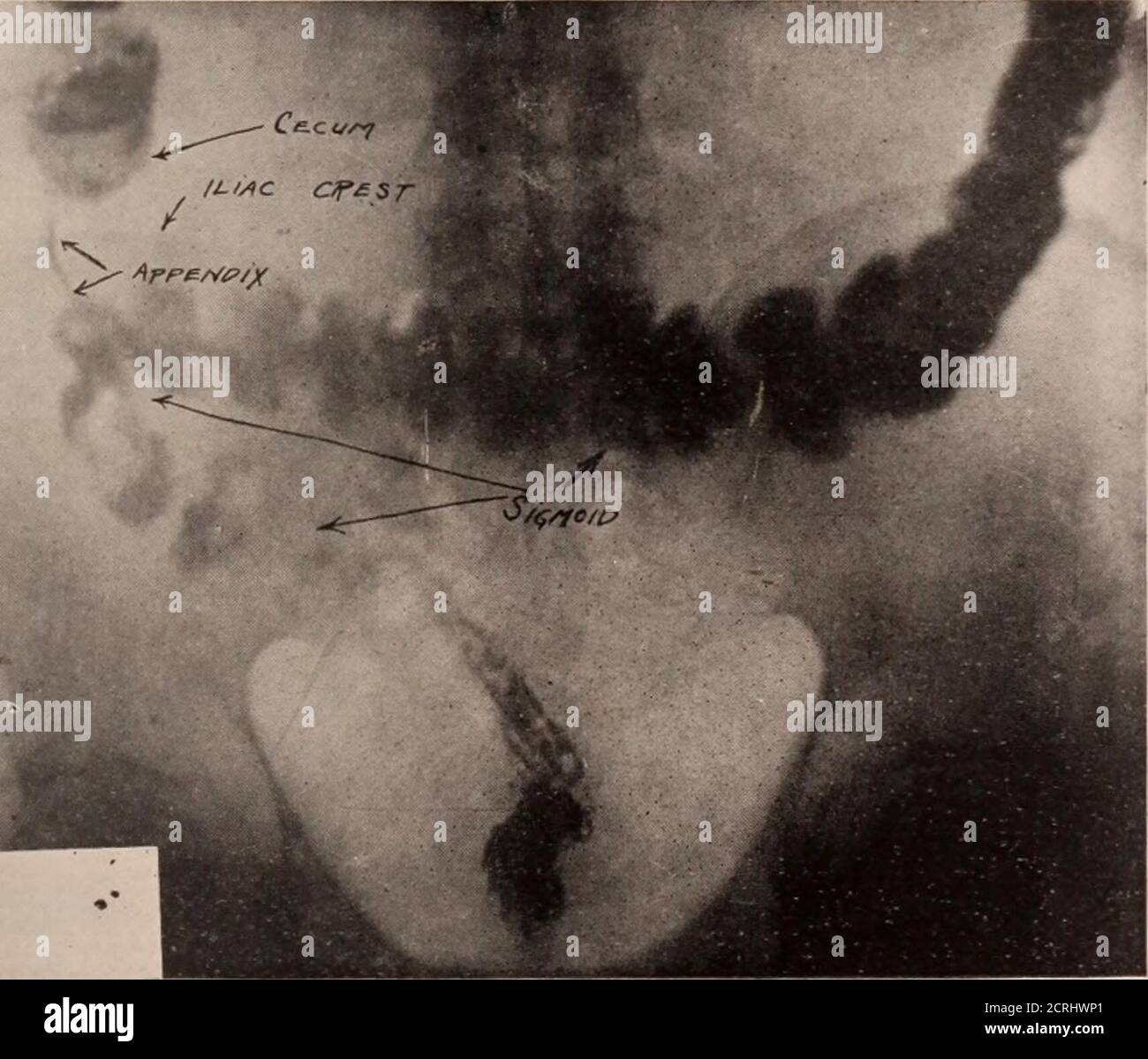 . Journal of radiology . rig-. 12.—Wide hepatic ttexure, relatively ...