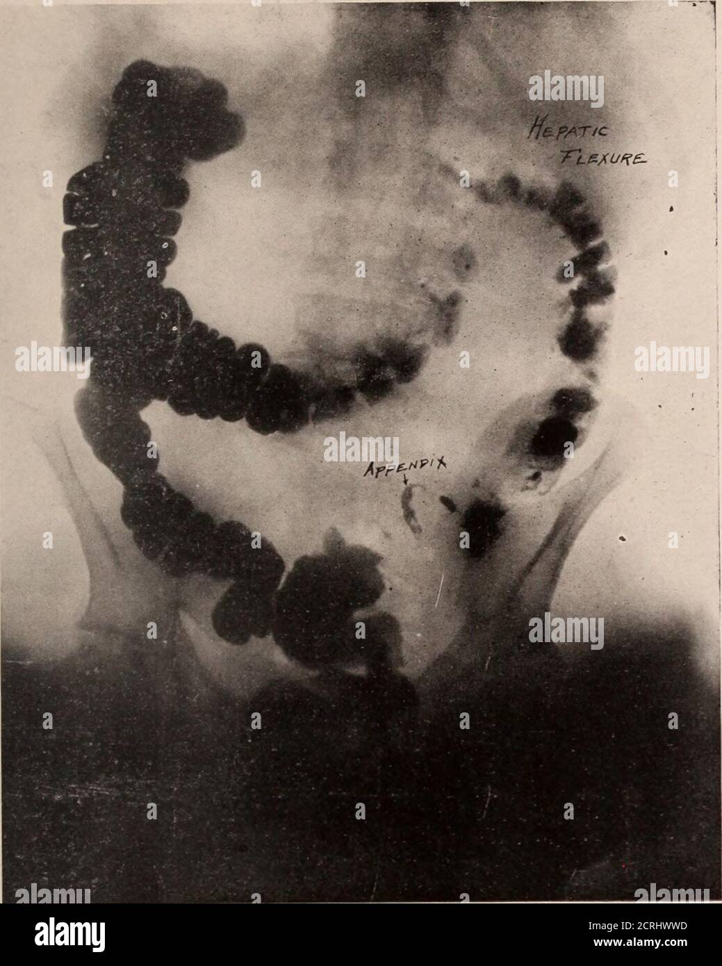 Hepatic flexure hires stock photography and images Alamy