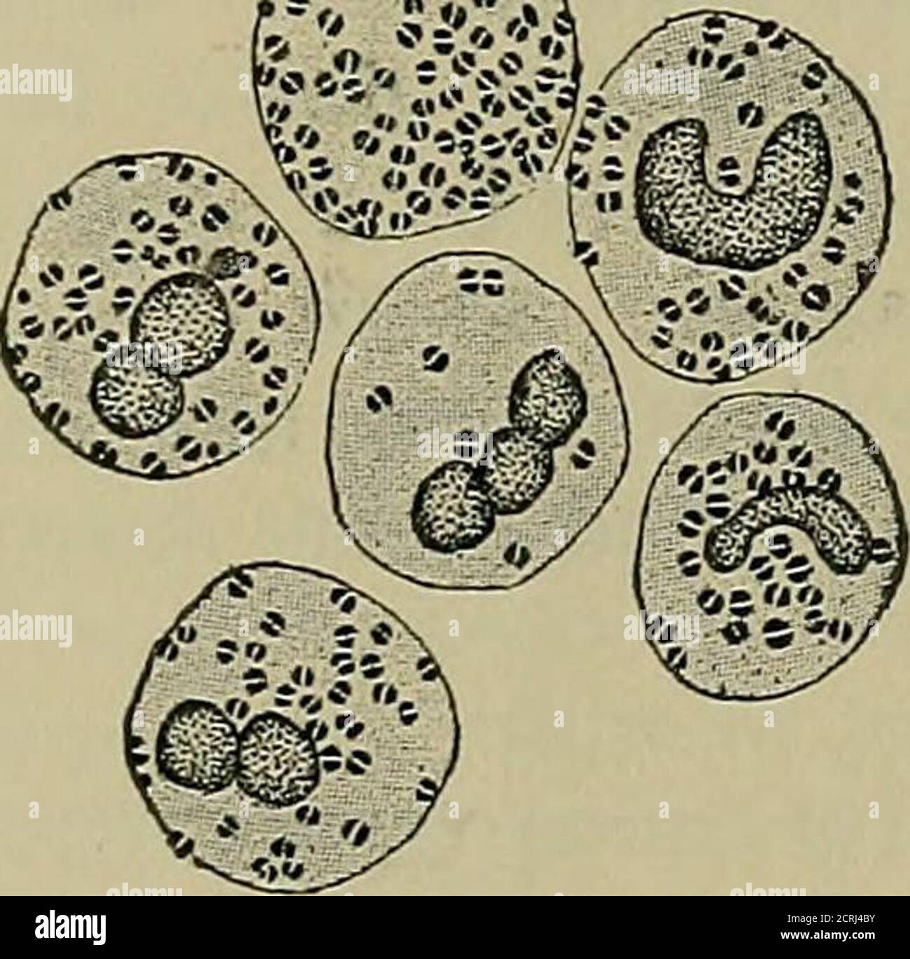 A practical treatise on medical diagnosis for students and physicians .  Fig. 316.—Pus-cells containing diplococci from the meninges. A few  diplococci are in the exudateoutside of the pus-cells. Between the pus-cells