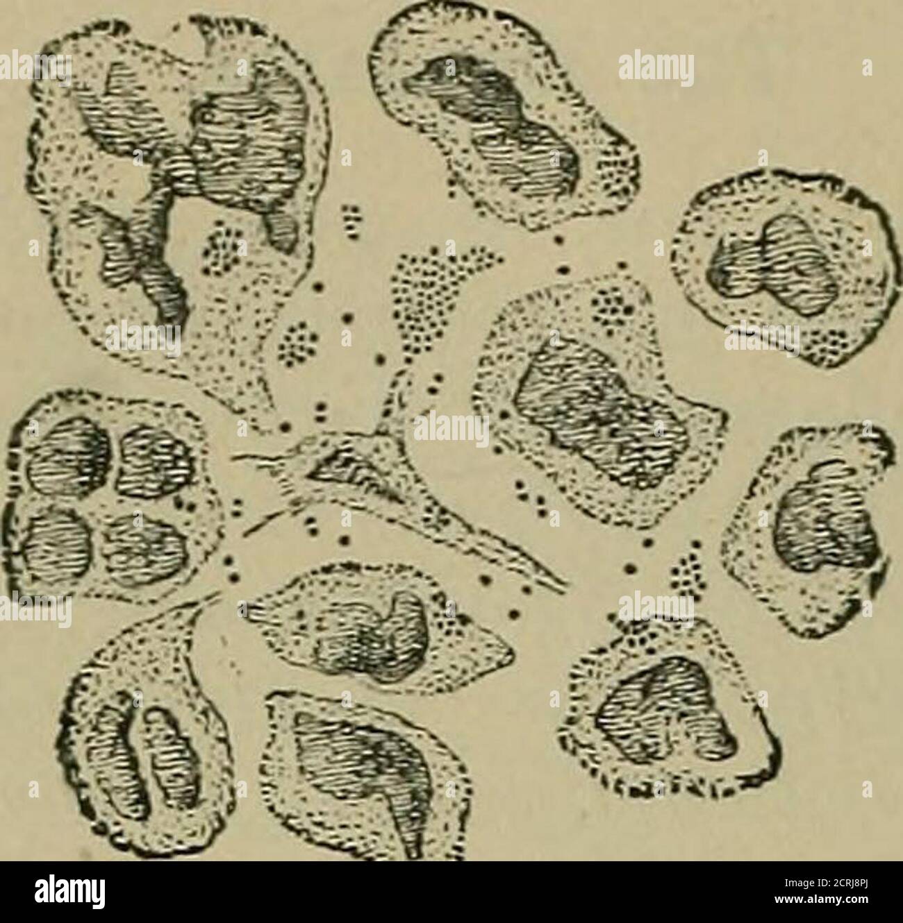 . A practical treatise on medical diagnosis for students and physicians . iortals, it may enter the tissue through abrasions or the hair-follicles. Morphology. In cover-glass preparations they appear as small, roundbodies scattered among the j)us-cells, rarely within them, single, in pairsor in clusters. Thev stain readily with the basic aniline dyes. (SeeFig. 275.) Fig. 275.. m ^ci ■^■r^:i Pus with staphylococcus. X 800. (FLrGGE.) 2. Staphylococcus Pyogenes Albus. It is also found in acute abscesses,but less often than the aureus, and is less virulent. It is morpholog-ically identical with th Stock Photo