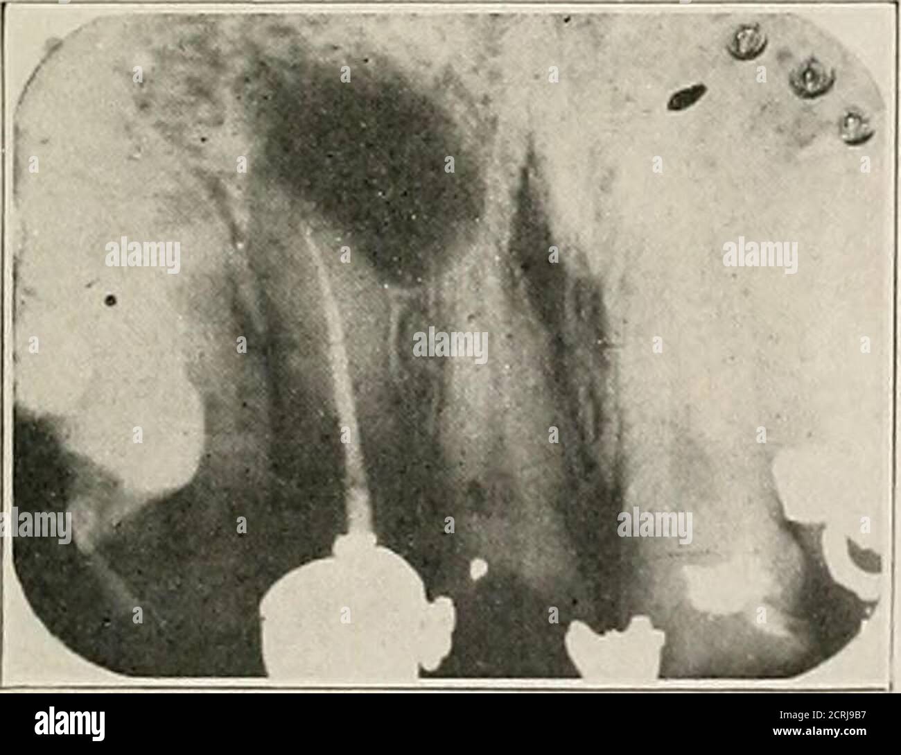 Double Root Canal High Resolution Stock Photography And Images Alamy Double Root Canal High Resolution Stock Photography And Images Alamy