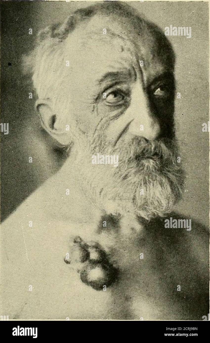 . Röntgen ray diagnosis and therapy . Fig. 306.—Osteosarcoma of ...