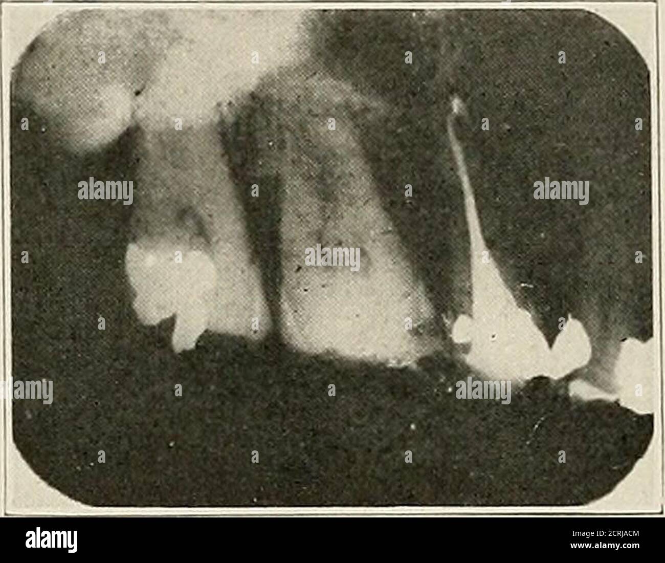 dental root canal afee retro dental root canal afee retro