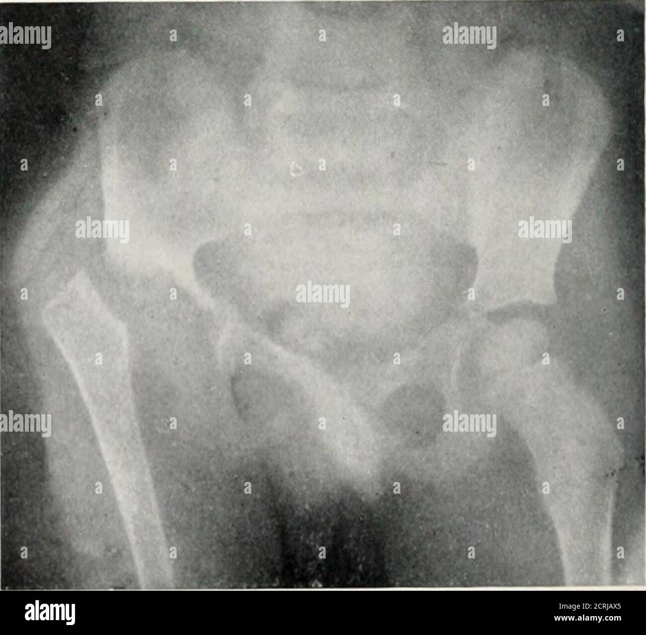 . Radiography, X-ray therapeutics and radium therapy . PLATE WII.—Injuries and Disease of Pelvis and Hip-joint. a, Fracture of pelvis in a child ; the injury lias occurred a1 both puhic bones, and on one sidethrough the ischium. b, Fracture of neck of femur, impaction into great trochanter. c, Displacement of ripper end of femur in a child. The acetabulum is eroded and the head of femursent. This is probably the result of tuberculosis. The appearances are similar to those of con- gi nii.ll dislocation. DISEASES OF BONE All varieties of bone disease are met with in the radiographic examinationo Stock Photo
