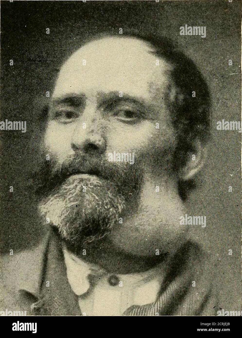 . Röntgen ray diagnosis and therapy . e areaof mammary amputation re-mained normal. From the observations ofthe case illustrated by Figs.278 and 279 valuable informa-tion can be gained. At the time the patient was presented to the American Therapeutic So-ciety, May 15, 1902, she was fifty-nine years old. She began tosuffer from carcinoma of the breast ten years before. After having been operated upon ten timesshe enjoyed fairly good health(Fig. 278). The result of theauthors first operation, per-formed in February, 1894, wasillustrated in the ClinicalRecorder, October, 1896 (Fig.279). She had Stock Photo
