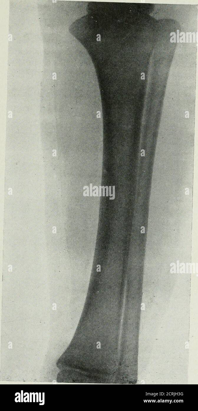 . The Roentgen rays in medicine and surgery as an aid in diagnosis and ...