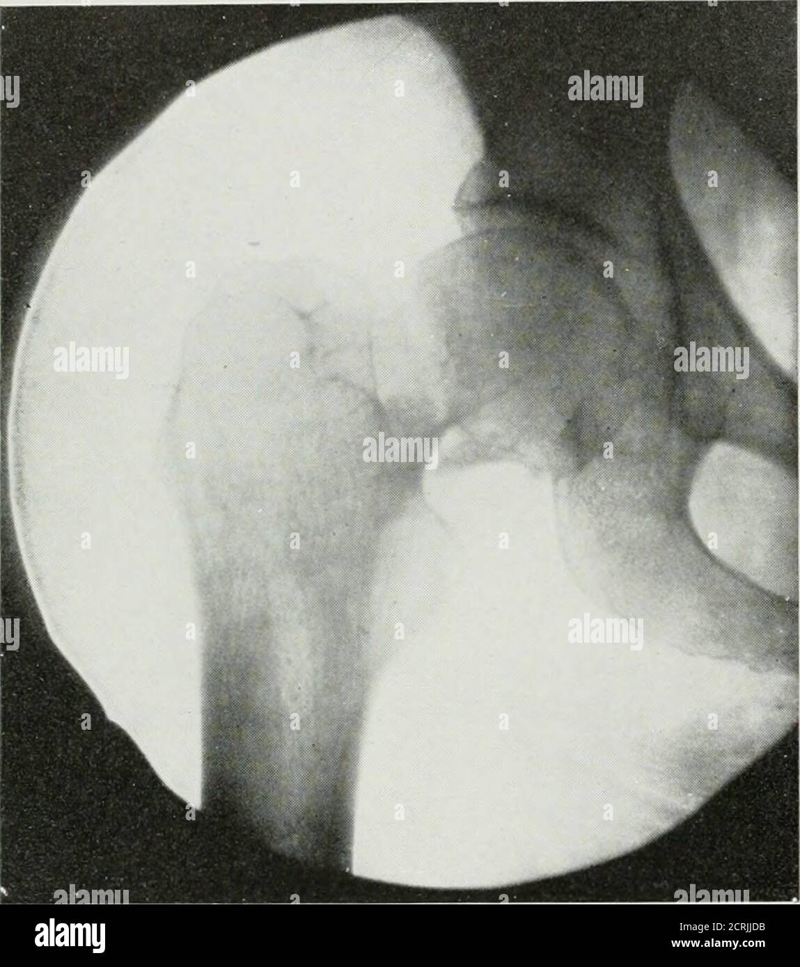 . The American journal of roentgenology, radium therapy and nuclear medicine . Fig. 9. Case Xo. 4859. Same Case as Fig. 8, SixMonths Later. Picture shows repair in spine and long union oftransverse processes showing that the transverse proc-esses wUl unite if not too widely separated. Thispatient has no paralysis and practically no disability. 462 Functional Disability Following Fractures with overriding of the fractured endscausing a dislocation of the head of theradius. This complication may easily beoverlooked. One case was observed inwhich the dislocation recurred three tim.es,. Fig. 10. C Stock Photo