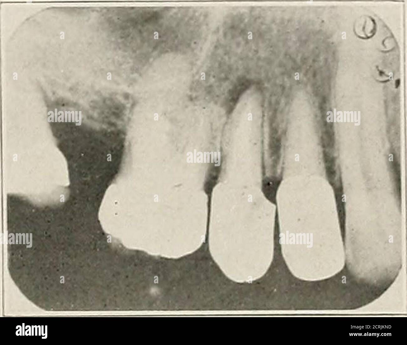 . Interpretation of dental and maxillary roentgenograms . Fig. 150. Fig ...