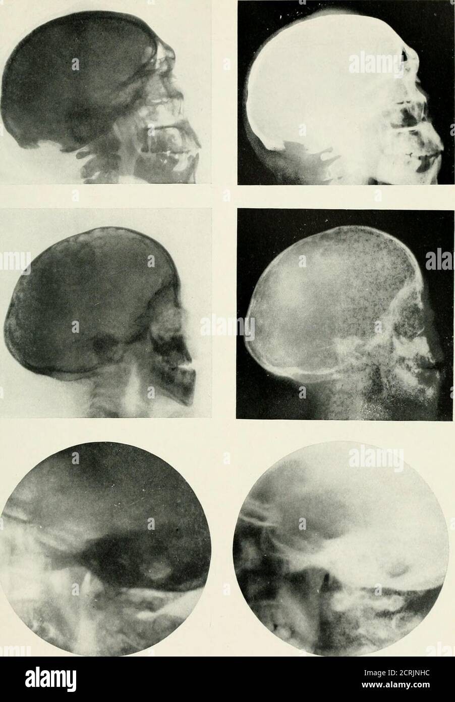 Anterior clinoid process hi-res stock photography and images - Alamy