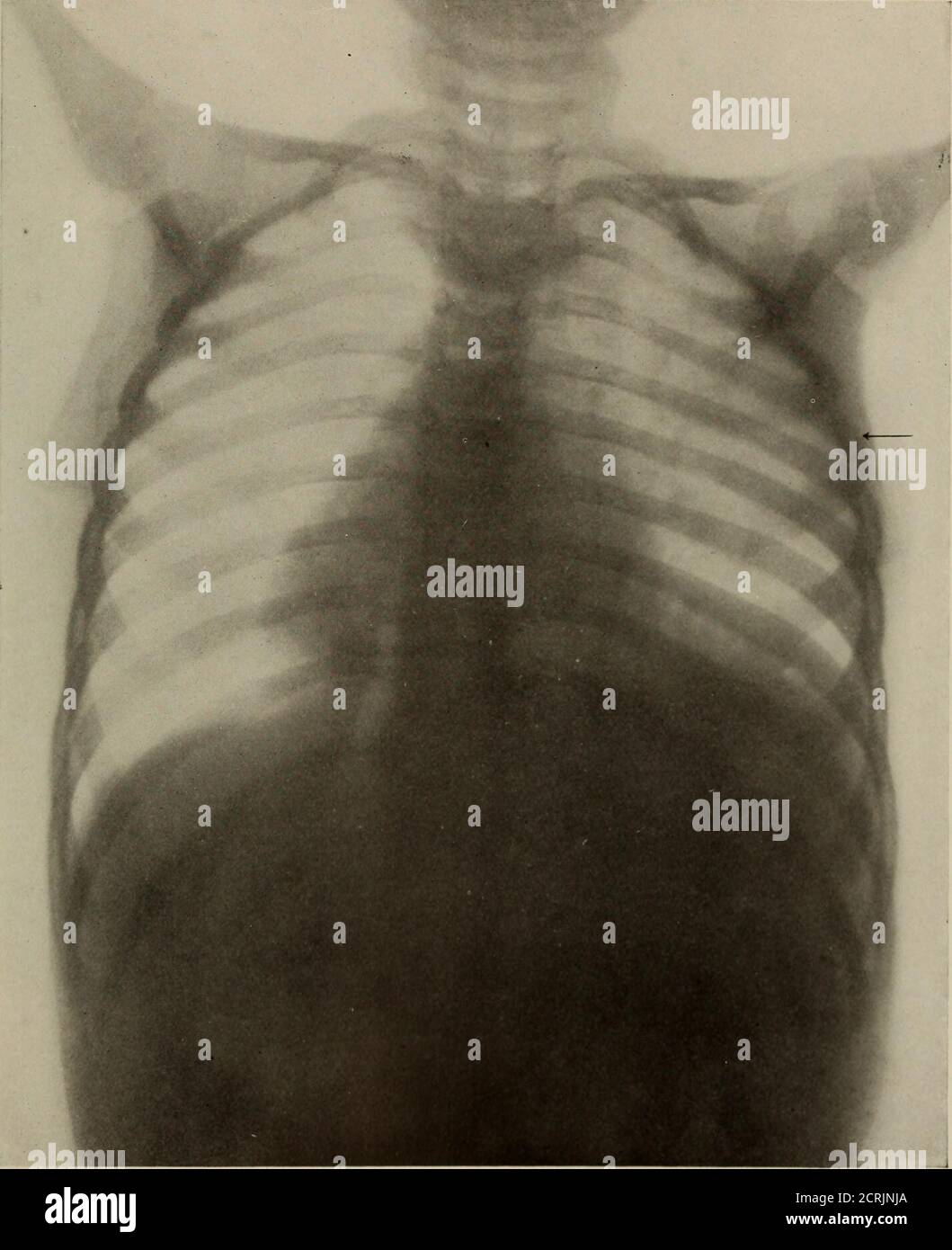Pneumonic infiltration hi-res stock photography and images - Alamy