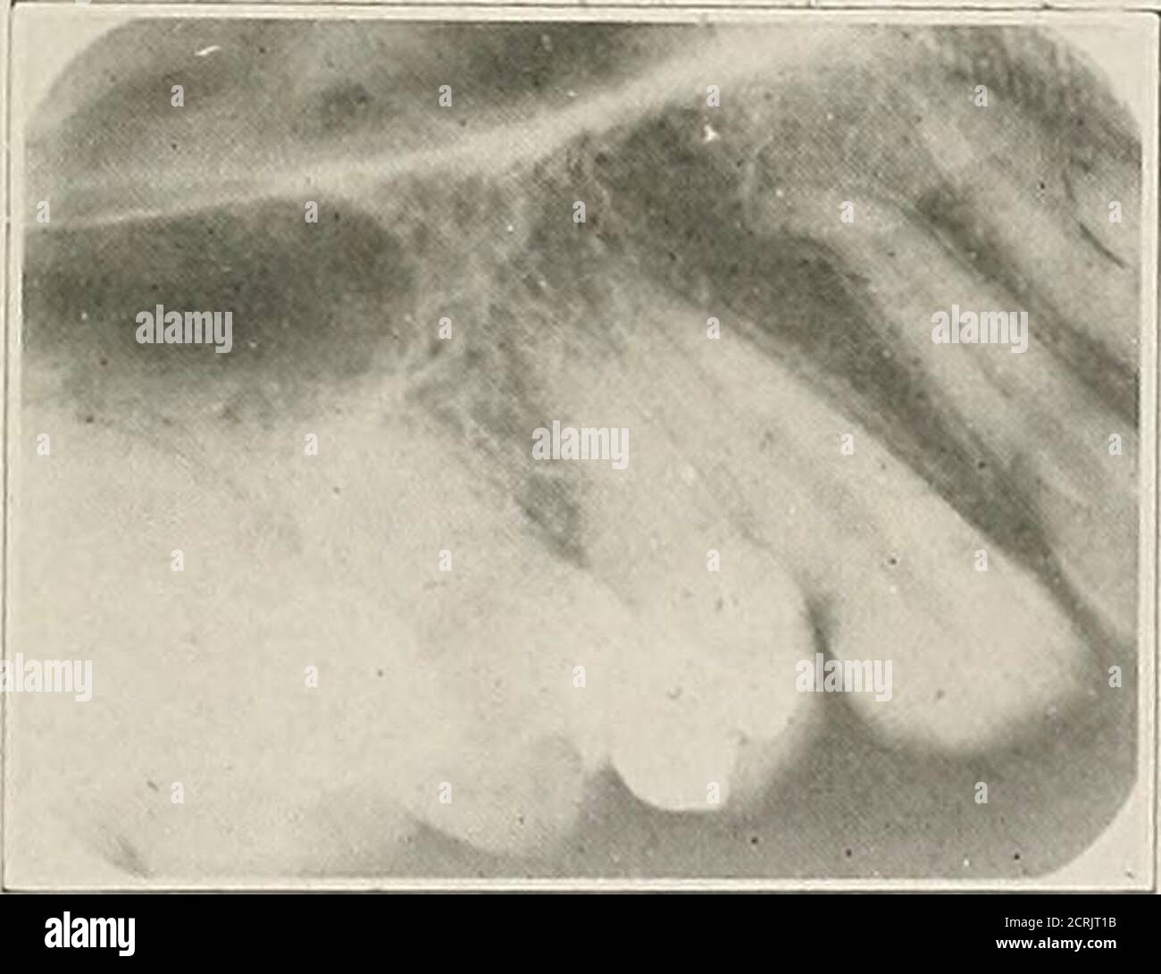 Interpretation Of Dental And Maxillary Roentgenograms Fig 118 Fig