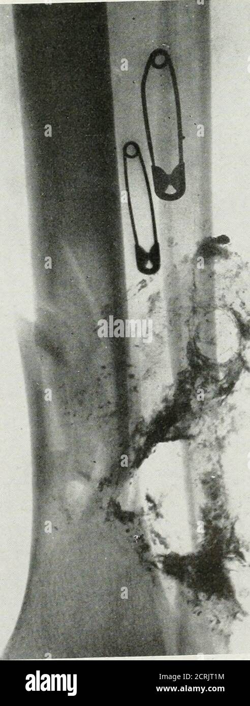 Marking Or Radium Wound in skin from hi-res stock photography and images - Alamy